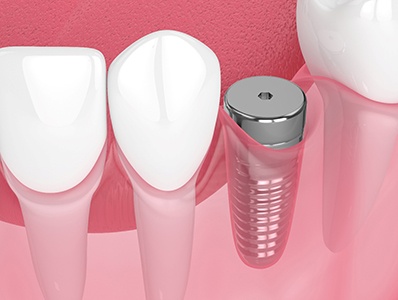 Digital illustration of dental implant