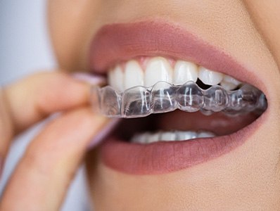 Illustration of a crossbite