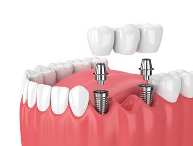 graphic of dental implant bridge