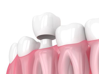 Animated smile during dental crown placement