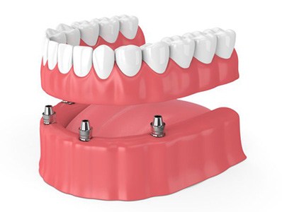 Animated smile during dental implant denture placement