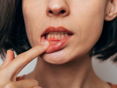Lady shows inflamed gum tissue