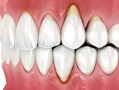 Illustration of gum recession