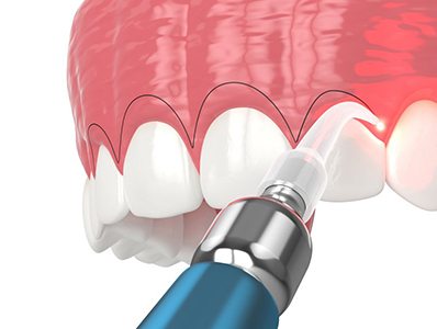 Illustration of laser periodontal treatment
