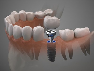 illustration representing cost of dental implants in Annandale