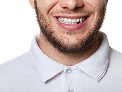 A close-up of a mouth with a single-tooth implant