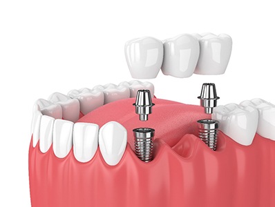 A 3D illustration of a dental bridge secured with two implants