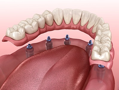 A 3D illustration of an implant denture 