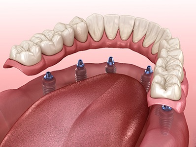 A 3D illustration of an implant denture