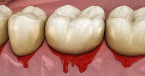 Animated smile with bleeding gums before periodontal disease treatment