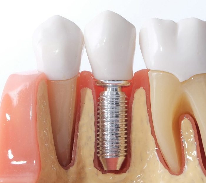 Model comparing dental implant supported tooth with natural teeth