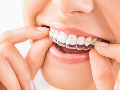 Closeup of patient wearing Invisalign in Annandale 