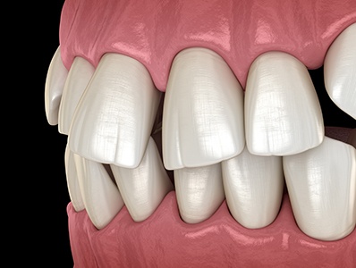 Illustration of crowded teeth
