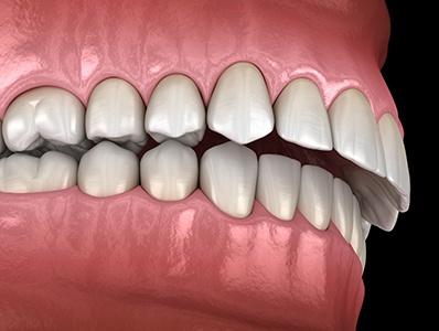 Illustration of gapped teeth