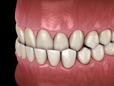 Illustration of an overbite