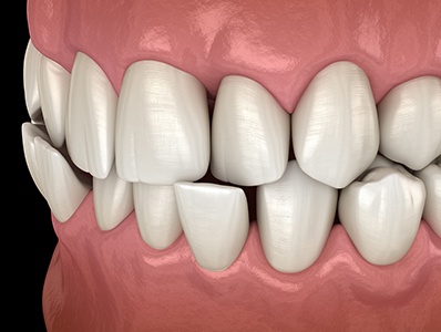 Illustration of an underbite