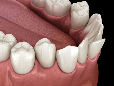 Illustration of a crossbite