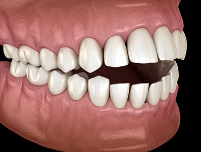 Illustration of an open bite