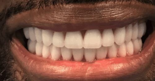 after full arch implant restoration