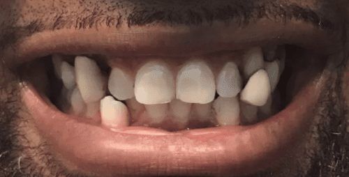Crooked teeth and misaligned smile before Invisalign clear braces and cosmetic dentist