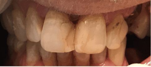 Severely damaged and decayed smile before dental restoration