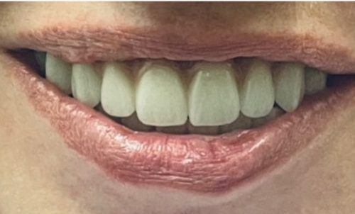 Healthy flawless smile after restortive dentistry