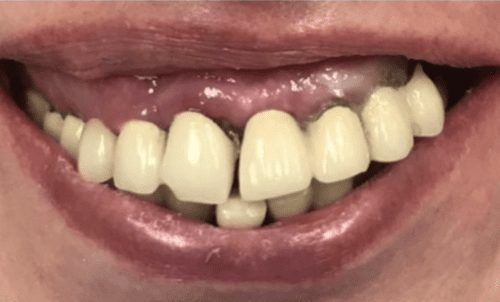 Smile with gum tissue and tooth damage before restorative dentistry