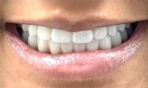 Full healthy smile after tooth replacement
