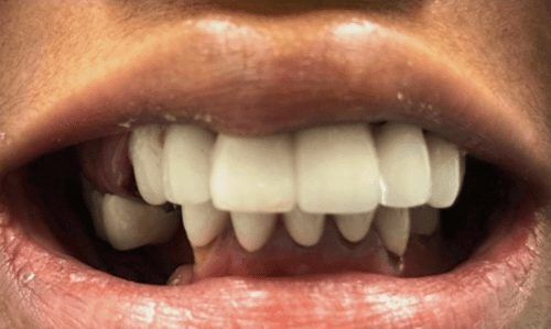 Smile with missing teeth before tooth replacement