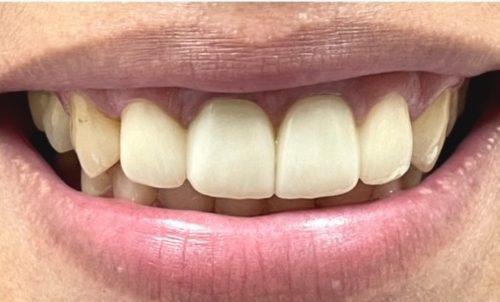 Flawless smile after cosmetic dnetistry to remove excessive gum tissues