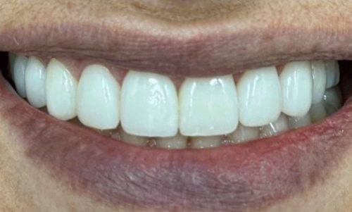 Healthy bright white smile after cosmetic dentistry