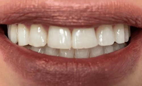 Discolored smile with several chipped and worn teeth