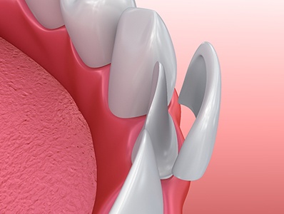 illustration of process for veneers in Annandale