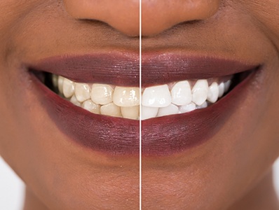 Patient's smile before and after teeth whitening