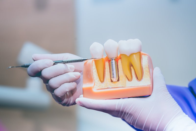 A hand holding a dental implant model