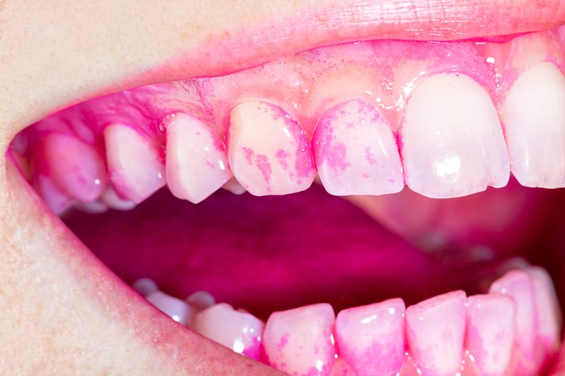 Teeth that have been treated DIY with moldable wax gone wrong.