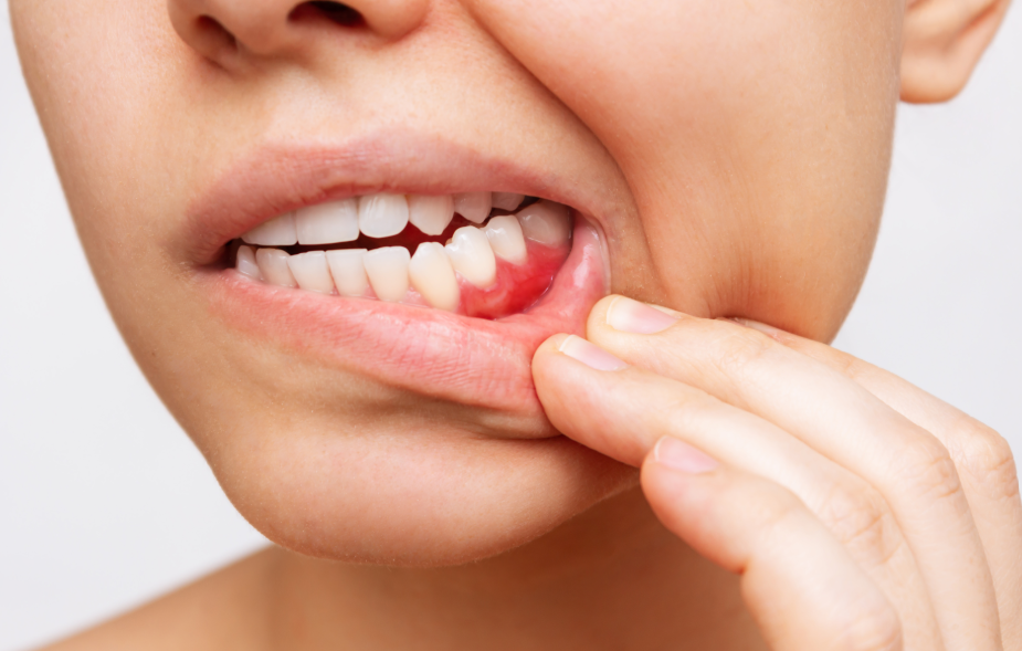 Woman pulling lip down to show inflamed gums